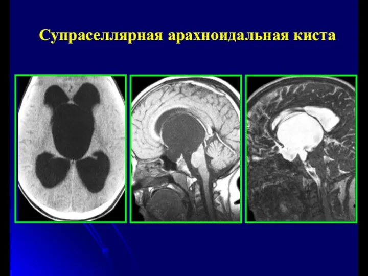 Супраселлярная арахноидальная киста