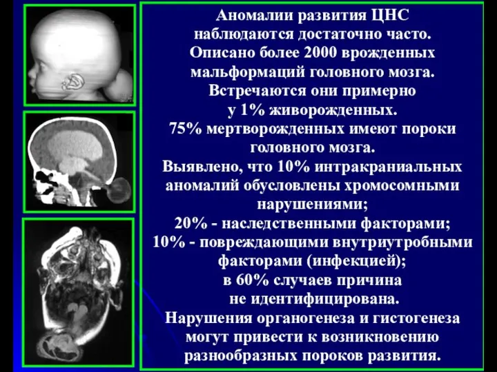 Аномалии развития ЦНС наблюдаются достаточно часто. Описано более 2000 врожденных мальформаций