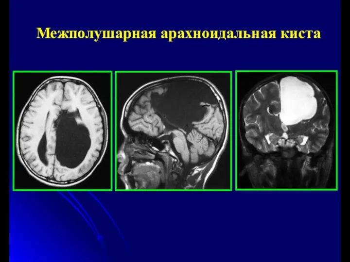 Межполушарная арахноидальная киста