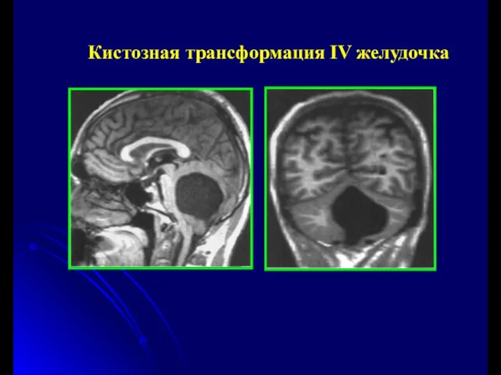 Кистозная трансформация IV желудочка