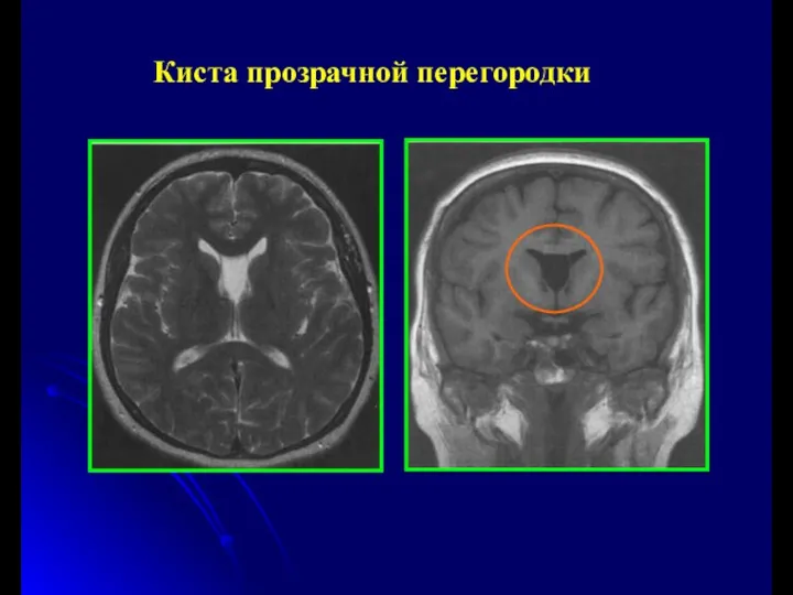 Киста прозрачной перегородки