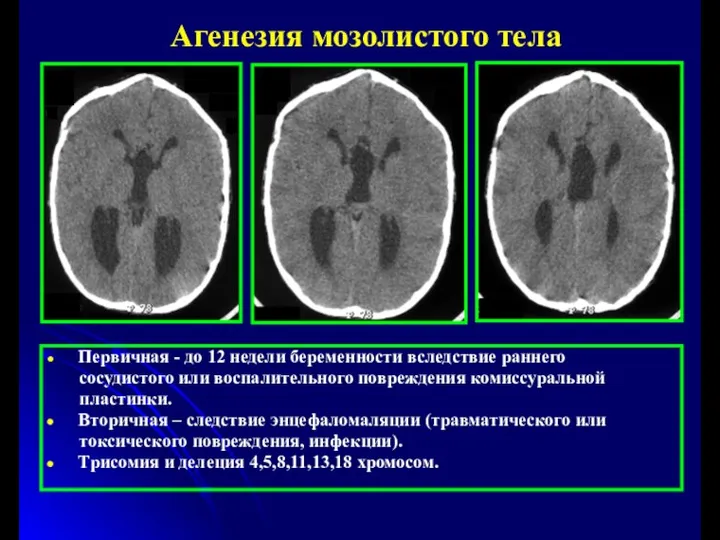 Агенезия мозолистого тела Первичная - до 12 недели беременности вследствие раннего