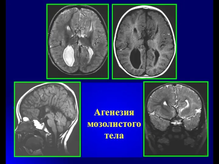 Агенезия мозолистого тела