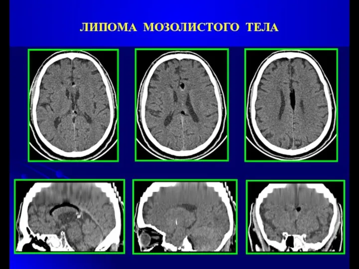 ЛИПОМА МОЗОЛИСТОГО ТЕЛА