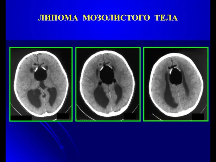 ЛИПОМА МОЗОЛИСТОГО ТЕЛА