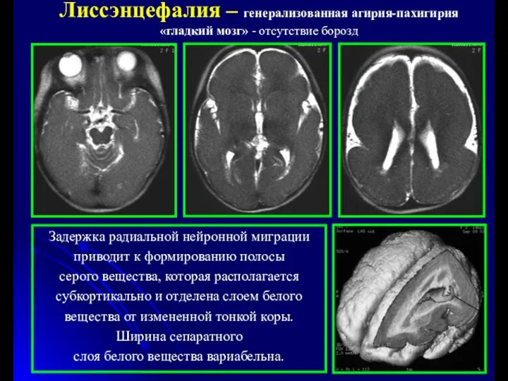 Лиссэнцефалия – генерализованная агирия-пахигирия «гладкий мозг» - отсутствие борозд Задержка радиальной