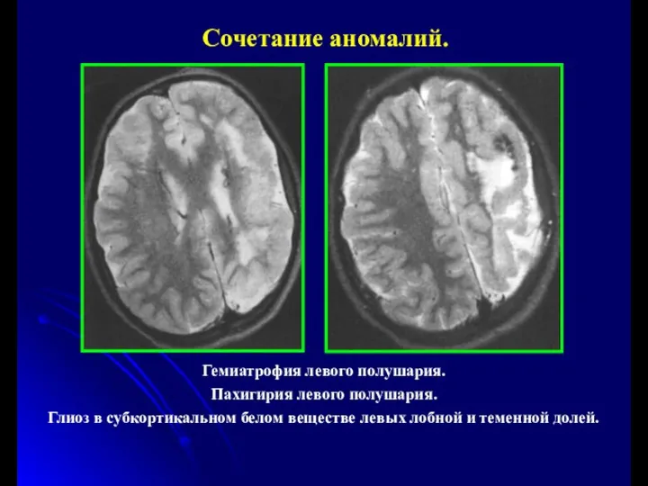 Сочетание аномалий. Гемиатрофия левого полушария. Пахигирия левого полушария. Глиоз в субкортикальном