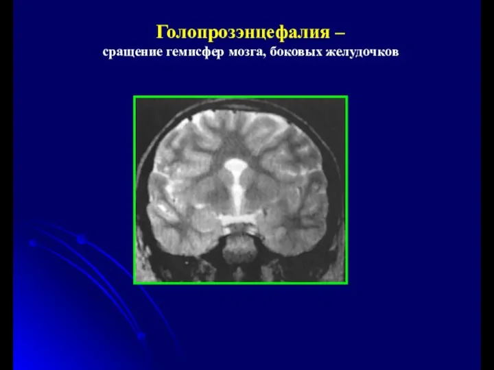 Голопрозэнцефалия – сращение гемисфер мозга, боковых желудочков