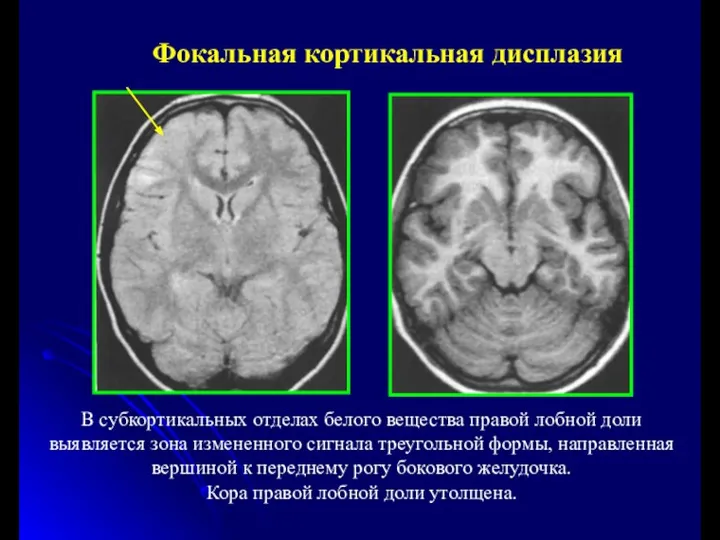 Фокальная кортикальная дисплазия В субкортикальных отделах белого вещества правой лобной доли