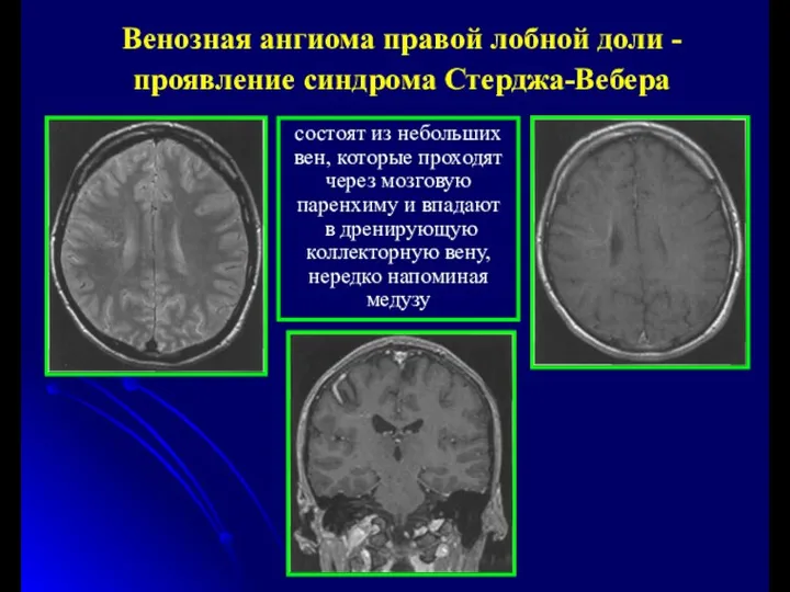 Венозная ангиома правой лобной доли - проявление синдрома Стерджа-Вебера состоят из