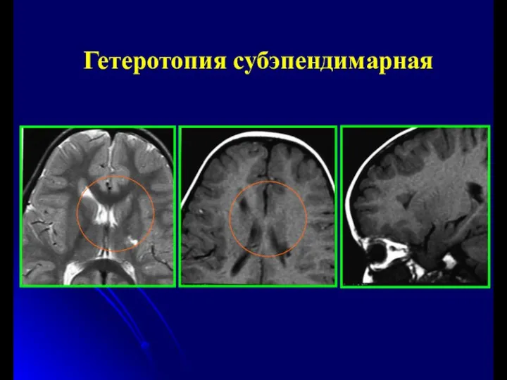 Гетеротопия субэпендимарная