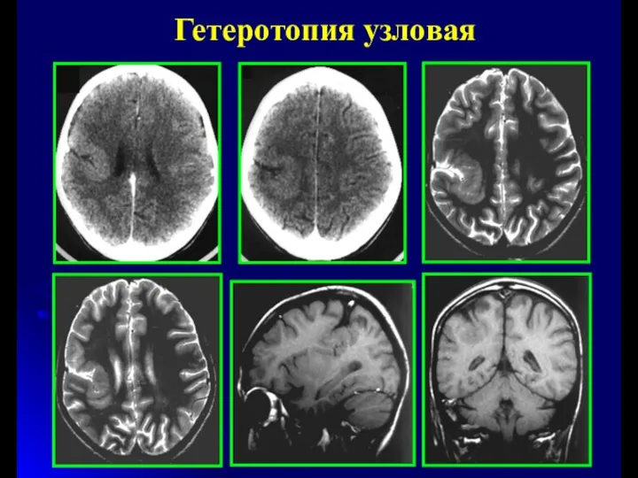 Гетеротопия узловая