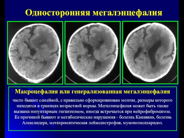 Односторонняя мегалэнцефалия Макроцефалия или генерализованная мегалэнцефалия часто бывает семейной, с правильно