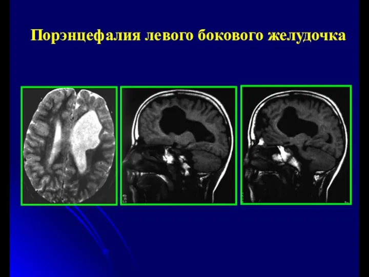 Порэнцефалия левого бокового желудочка