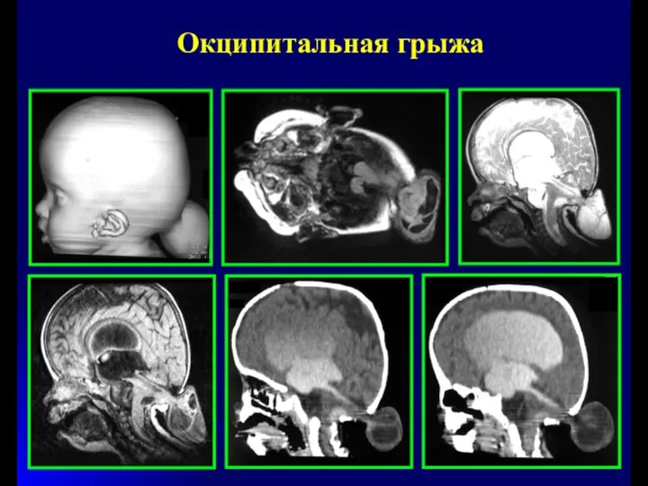 Окципитальная грыжа