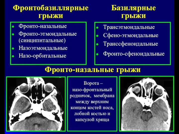 Фронтобазиллярные грыжи Фронто-назальные Фронто-этмоидальные (синципитальные) Назоэтмоидальные Назо-орбитальные Базилярные грыжи Трансэтмоидальные Сфено-этмоидальные