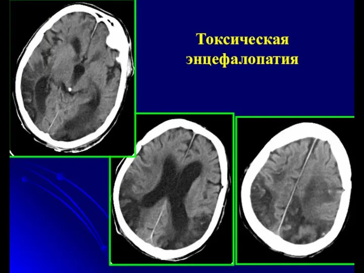 Токсическая энцефалопатия