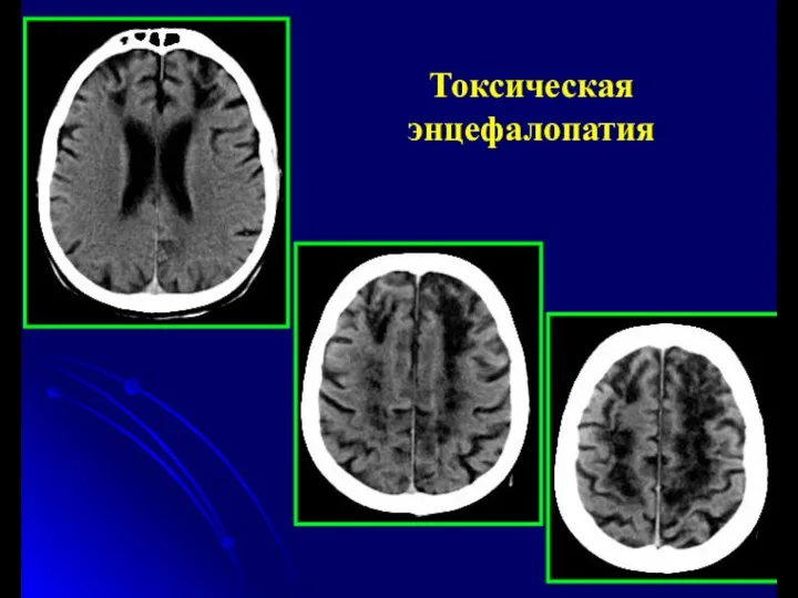 Токсическая энцефалопатия