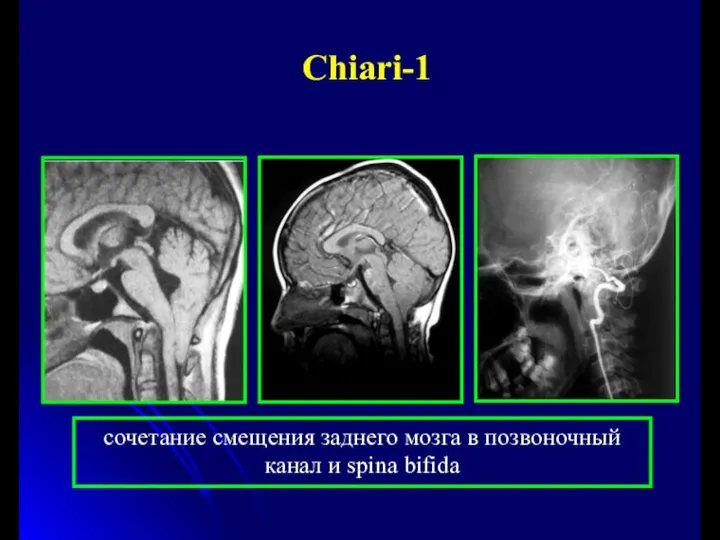 Сhiari-1 сочетание смещения заднего мозга в позвоночный канал и spina bifida