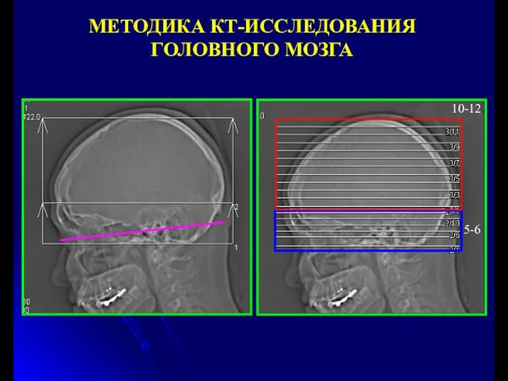 МЕТОДИКА КТ-ИССЛЕДОВАНИЯ ГОЛОВНОГО МОЗГА 5-6 10-12