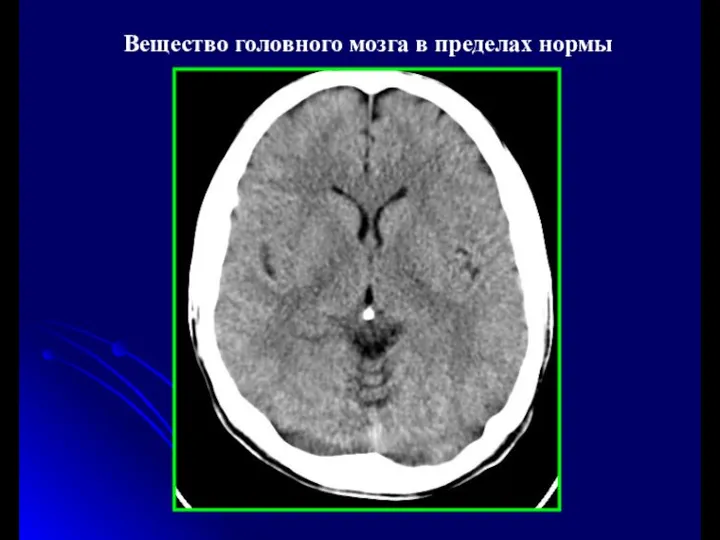 Вещество головного мозга в пределах нормы