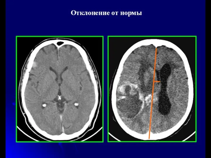 Отклонение от нормы