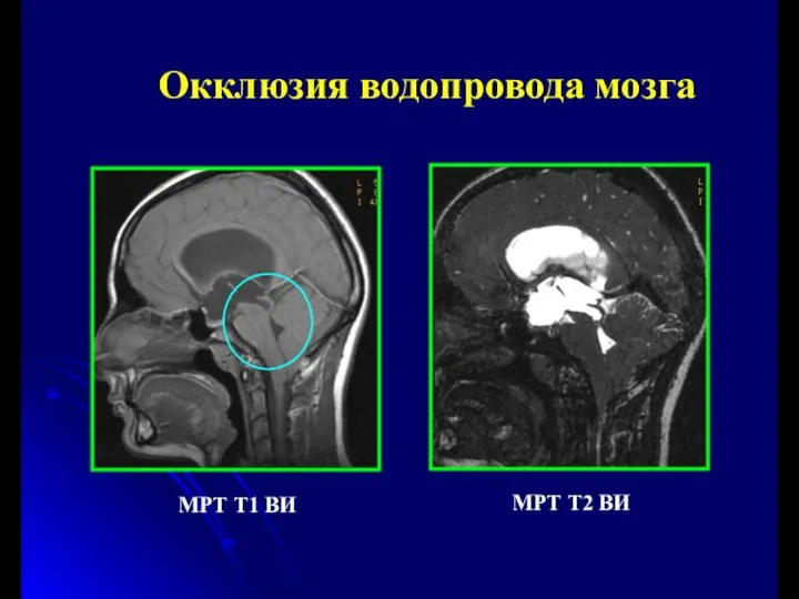 Окклюзия водопровода мозга МРТ Т1 ВИ МРТ Т2 ВИ