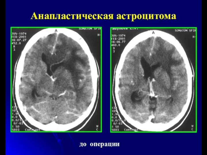 до операции Анапластическая астроцитома