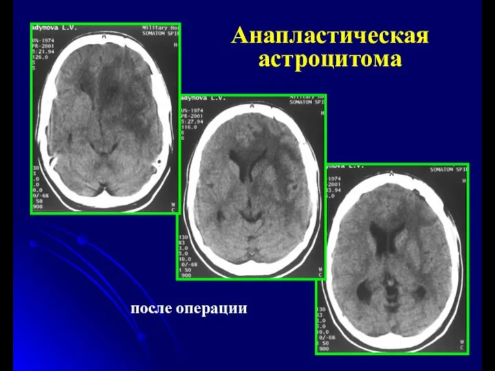 после операции Анапластическая астроцитома