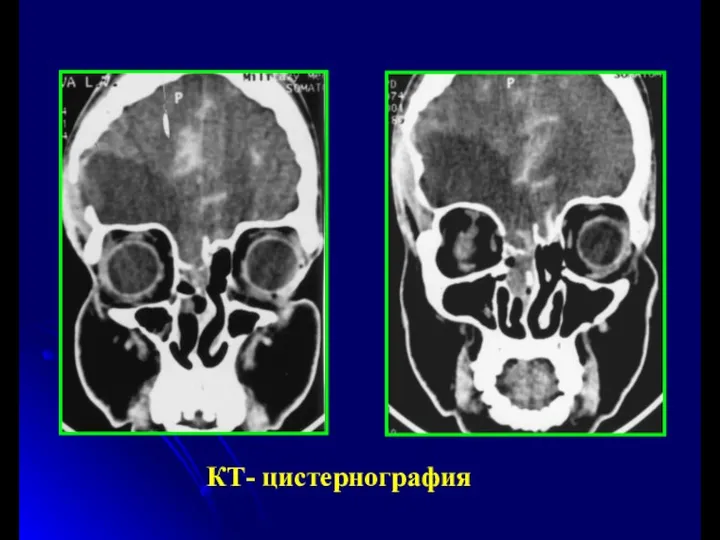 КТ- цистернография