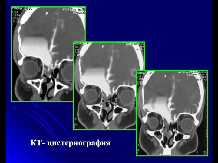 КТ- цистернография