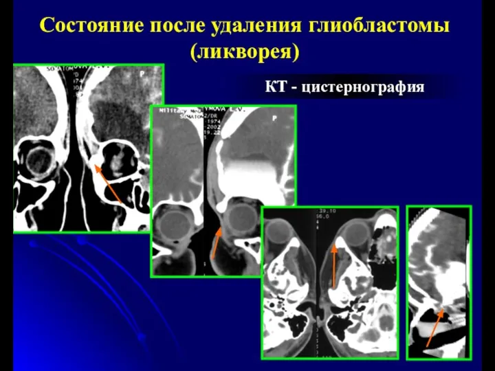 КТ - цистернография Состояние после удаления глиобластомы (ликворея)