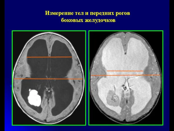 Измерение тел и передних рогов боковых желудочков