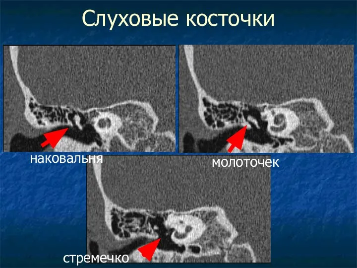 Слуховые косточки наковальня молоточек стремечко