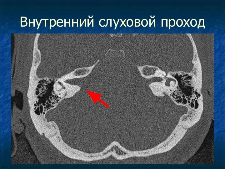 Внутренний слуховой проход