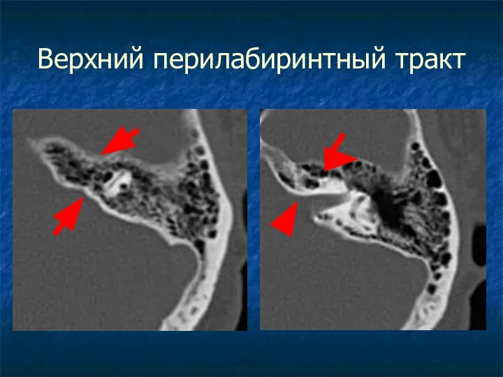 Верхний перилабиринтный тракт