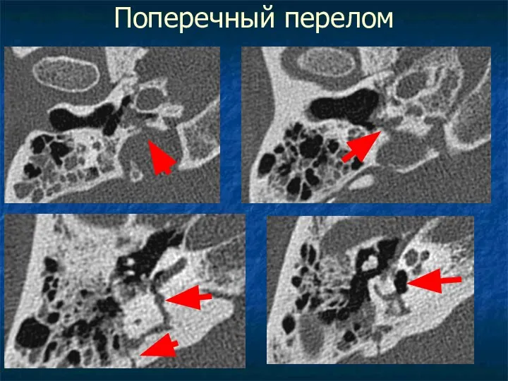 Поперечный перелом