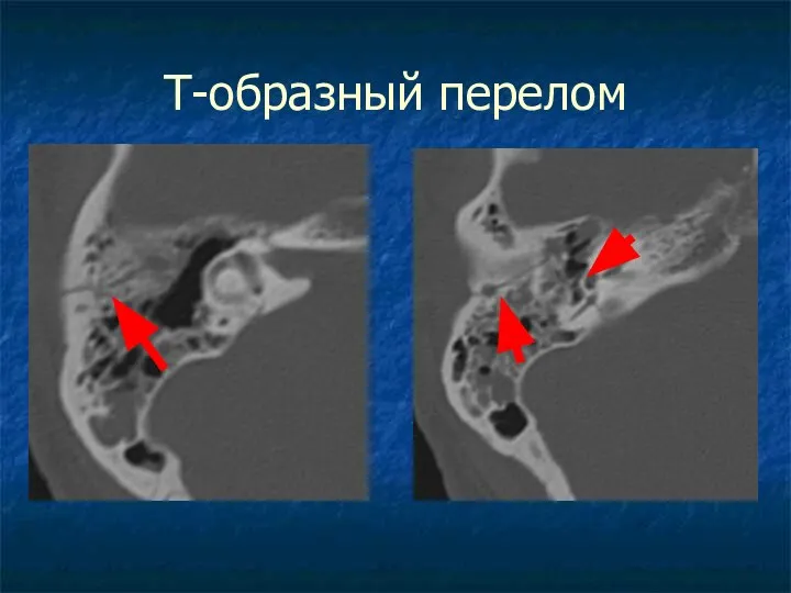 Т-образный перелом