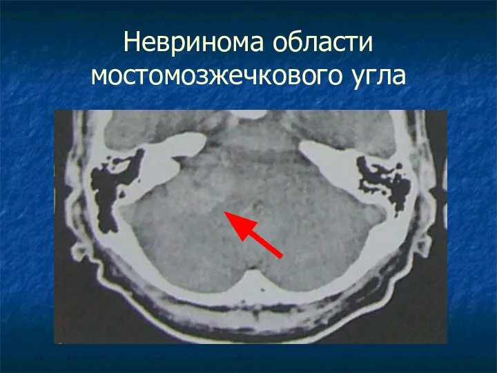 Невринома области мостомозжечкового угла