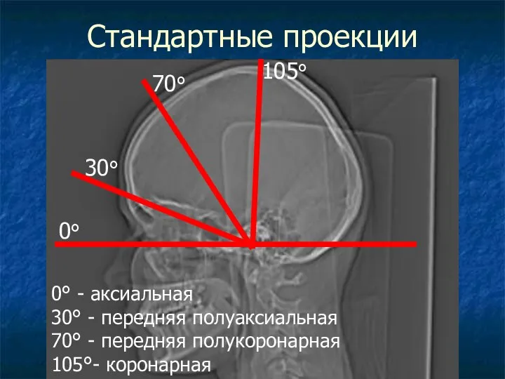 Стандартные проекции 0° 30° 70° 105° 0° - аксиальная 30° -