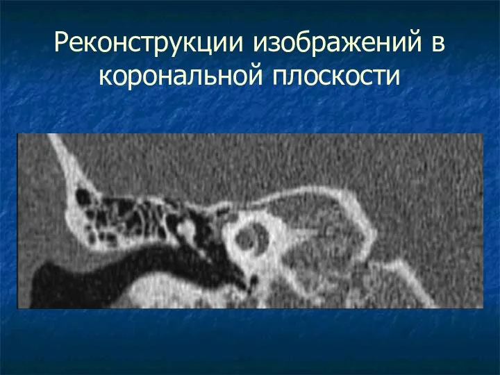 Реконструкции изображений в корональной плоскости