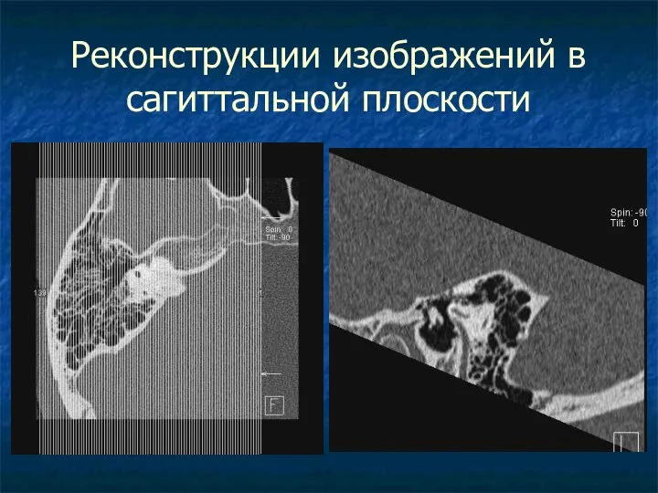 Реконструкции изображений в сагиттальной плоскости