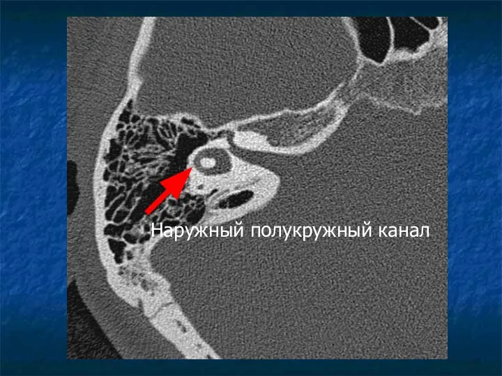 Наружный полукружный канал