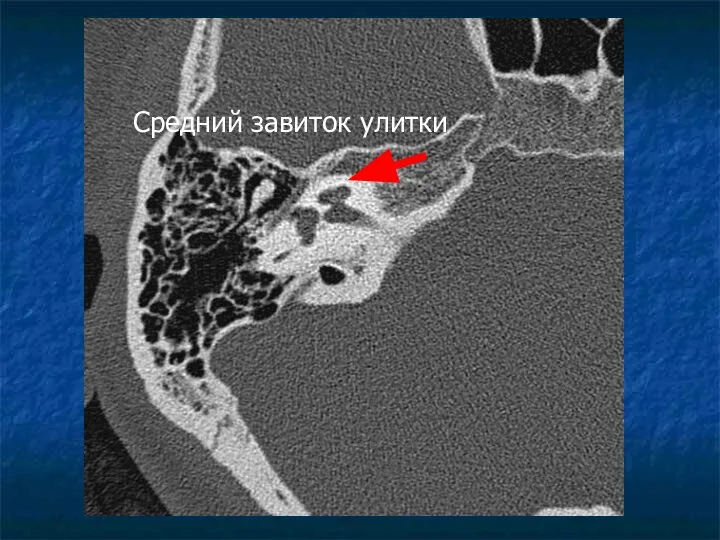 Средний завиток улитки