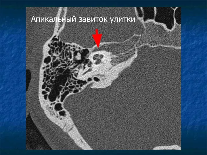 Апикальный завиток улитки