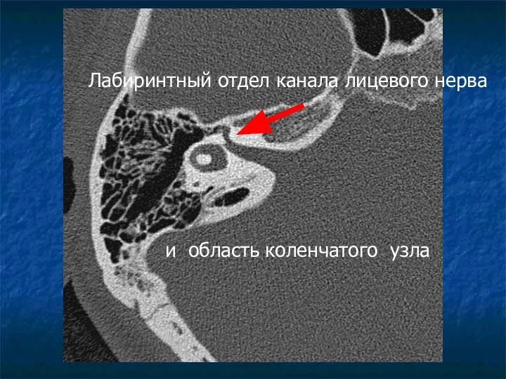 Лабиринтный отдел канала лицевого нерва и область коленчатого узла