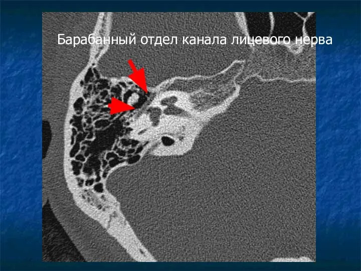 Барабанный отдел канала лицевого нерва