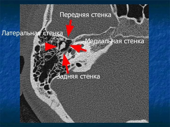 Передняя стенка Медиальная стенка Задняя стенка Латеральная стенка