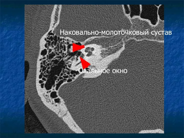 Наковально-молоточковый сустав Овальное окно