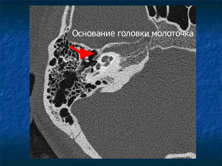 Основание головки молоточка